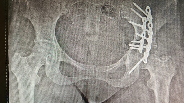 orthopedic-surgeon-dehradun-medika-orthopedic-27.jpg